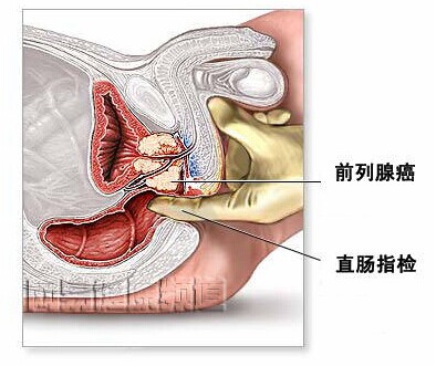 前列腺癌