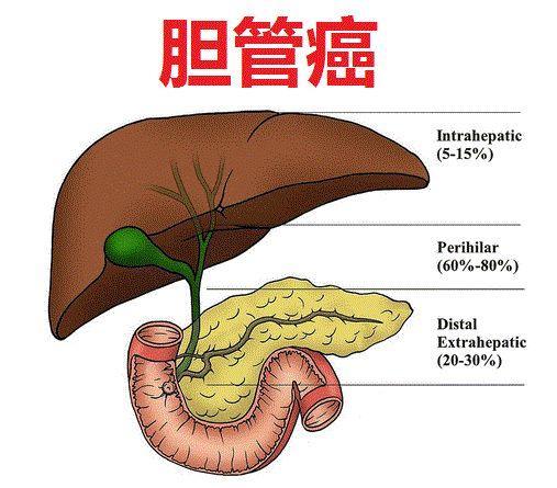 Durvalumab联合化疗使胆道癌患者总体生存率获益