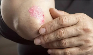 Envudeucitinib 安全性深度解读